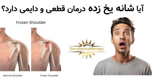 آیا شانه یخ زده درمان قطعی و دایمی دارد؟