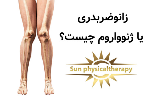 زانوضربدری یا ژنوواروم چیست؟